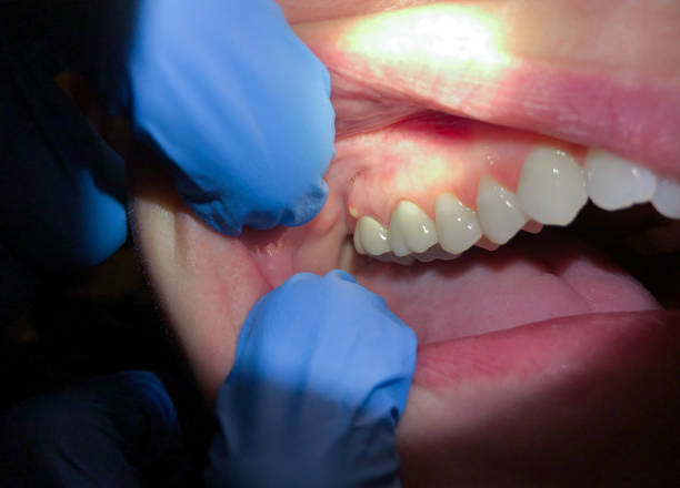 Best Emergency Tooth Extraction in Gardiner, ME